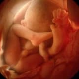 Fetal anomaliler hakkında genel bilgiler