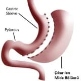 Sleeve gastrektomi (tüp mide)