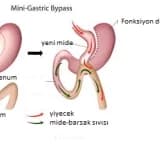 Laparoskopik gastrik by pass (mide by pass’ı)