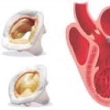 Mitral kapak ameliyatı