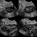 Polikistik over sendromu ( pcos)