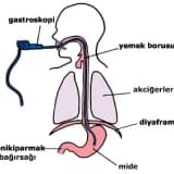 Gastroskopi