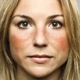 Lupus nedir?