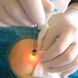 Duktoskopi nedir?