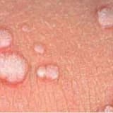 Genital siğil ve tedavi yontemleri