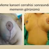 Meme kanserine estetik çözüm; onkoplastik cerrahi