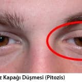 Tek taraflı göz kapağı düşmesi (pitozis)