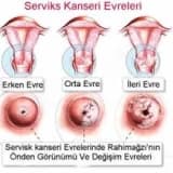 Serviks Kanseri, Tanısı, Tedavisi, Aşı ile Korunması Nasıldır?