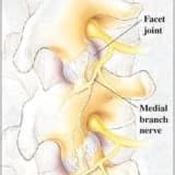 Faset Eklem Blokajı – Faset Medial Dal Blokajı ve RFT