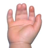 Yapışık parmak sendromu (Sindaktili)