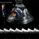 Doppler Ultrasonografi nedir?