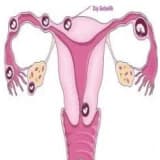 Dış Gebelik (Ektopik Gebelik ) Nedir ?
