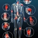 OSTEOARTRİT ( KİREÇLENME )