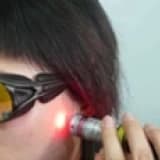 Soft Laser Needle Tedavileri