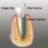 Diş implantları her yaşta uygulanabilir mi?