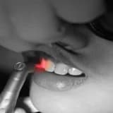 LAZER DESTEKLİ DİŞ HEKİMLİĞİ