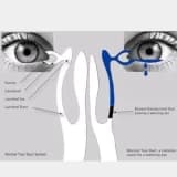 WHAT IS A BLOCKED TEAR DUCT ?