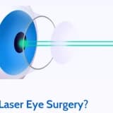 WHAT IS LASER EYE SURGERY?