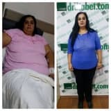 Obezite Cerrahisinin Psikolojik Etkileri