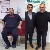 Tüp Mide Ameliyatı Nasıl Yapılır?