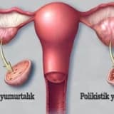 POLİKİSTİK OVER SENDROMU NEDİR?  (PCOS)