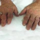 Gut hastalığı nedir ? Neler yasaktır ? Nasıl beslenilir ?