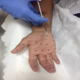 Aşırı Terlemede Botox Tedavisi!