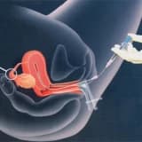 İntra Uterin İnseminasyon (Aşılama)
