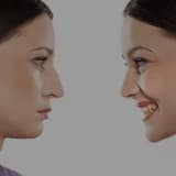 BURUN ESTETİĞİ (RHINOPLASTY) ve SIK SORULAN SORULAR