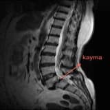 Bel Kayması (Spondilolistezis) Nedir ve Nasıl Oluşur?