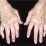 Romatoid Artrit ve Beslenme (Bağışıklığı güçlendiren yiyecekler)