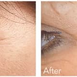 Botox nedir? Kimlere yapılabilir? Yan etkisi var mıdır? Ne zaman yapılmalıdır? Nerelere yapılabilir?