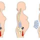 Gebelikte Sık Görülen Şikayetler- Bel Ağrıları