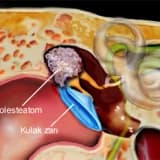 Kulak ZARI AMELİYATI - TİMPANOPLASTİ NEDİR?