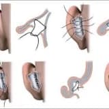 Otoplasti - Kepçe Kulak