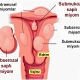 Miyomlar ve infertilite