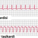 Çocuklarda çarpıntı olur mu?
