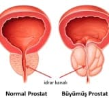 BPH (İyi Huylu Prostat Büyümesi)