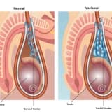 Varikosel nedir? Tanısı nasıl konulur? Tedavisi nedir?