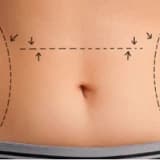 Karın Germe (ABDOMİNOPLASTY) Operasyonu Hakkında