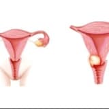 Genital Enfeksiyonlar ve Sebepleri