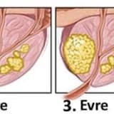 Prostatin iyi huylu büyümesi ve prostat kanseri