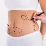Karın germe veya Abdominoplasti