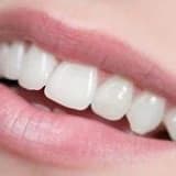 Estetik Diş Tedavisi Planlaması Nedir? Nasıl Yapılır?