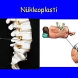LAZER (NÜKLEOPLASTİ) İLE BEL FITIĞI AMELİYATI
