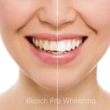 bleaching(ağartma)