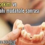Cerrahi müdahale ve diş çekimi sonrası