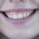 Gummy Smile (Dişetlerinin fazla görünmesi) ve Pembe Estetik Tedavisi