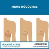 MEME KÜÇÜLTME AMELİYAT ÜCRETLERİ NASILDIR?