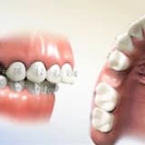 ORTODONTİK TEDAVİ İÇİN DİŞ ÇEKİMİ